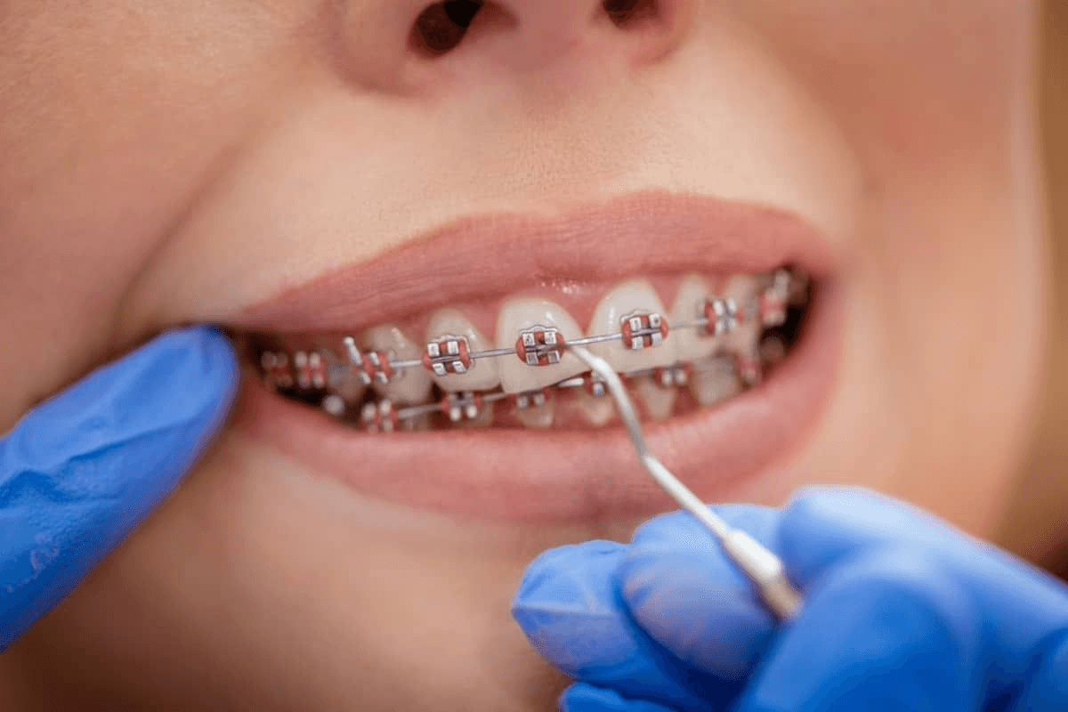 Dental brace fitting procedure